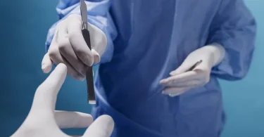 Vasectomy