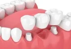Dental Bridges