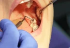 Teeth Removal