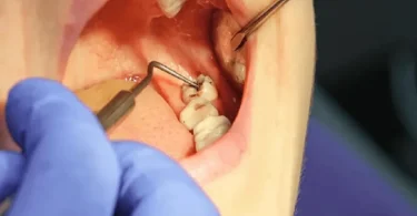 Teeth Removal